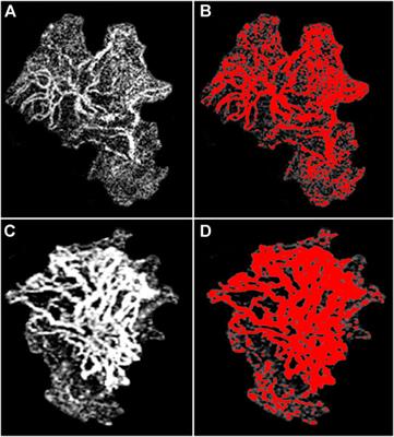 High Reflectivity and Low Reflectivity Properties on OCTA Influence the Detection of Macular Neovascularization in AMD